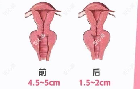 紧缩针在哪里预约？紧缩针预约方式全攻略